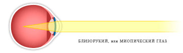 Близорукость, миопия
